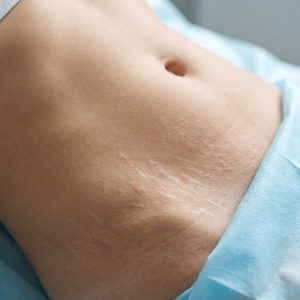 розтяжки на животі крупним планом фото